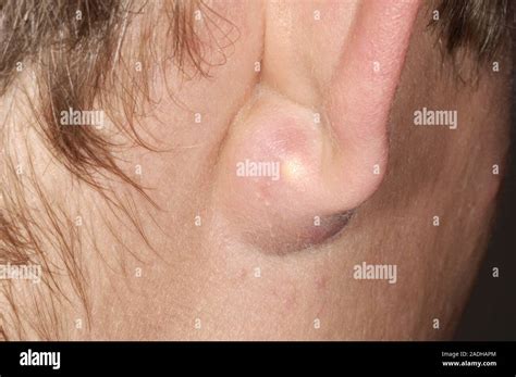 Infected sebaceous cyst behind the ear of a 22 year old man. Cysts are ...