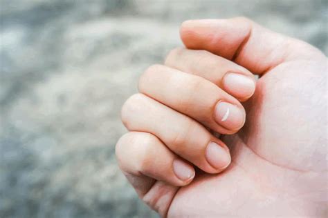 Manchas Na Unha Da Mão - Manchas brancas nas unhas da mão? Atenção para essas causas!