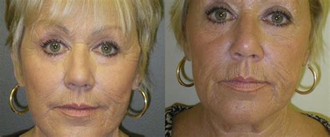 Plastic Surgery Near Me