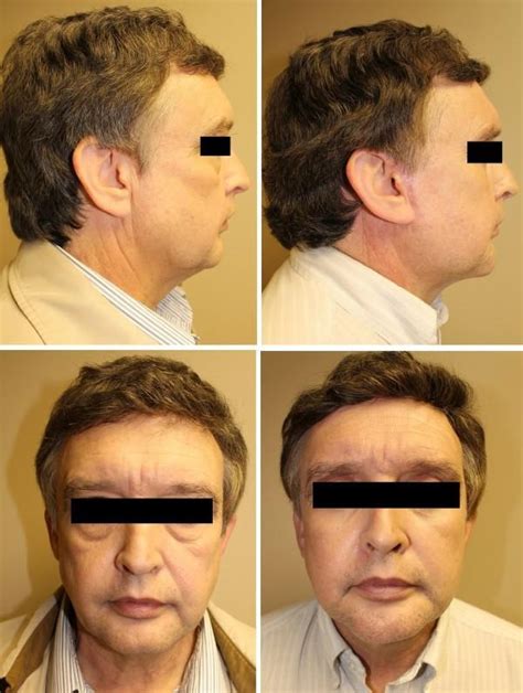 Rhytidectomy 20 | Roanoke Plastic Surgery | Norman Harris, MD