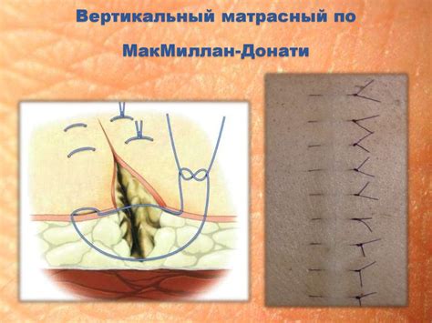 Основы кожной пластики и кожные швы - online presentation