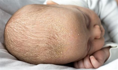 What to do About Cradle Cap | Boston Baby Nurse & Nanny