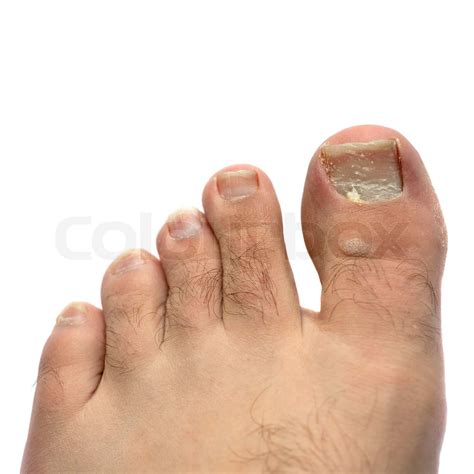 Closeup of a hairy human foot and toes with a cracked and peeling toe ...