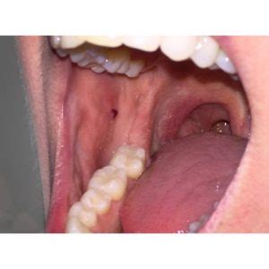 Does Your Mouth Look Like This? Blood Blisters