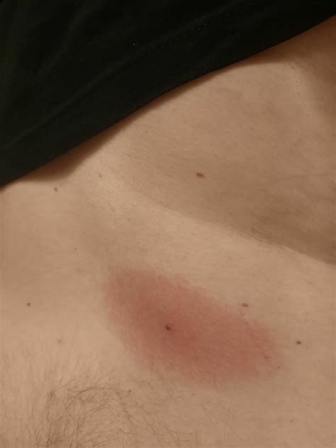 Does this look like a Lyme disease rash? : r/lymedisease