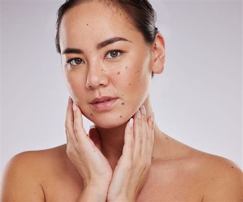 mole removal  dubai safe laser mole removal treatment