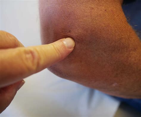 Tennis Elbow (Lateral Epicondylitis) - Comprehensive Orthopaedics