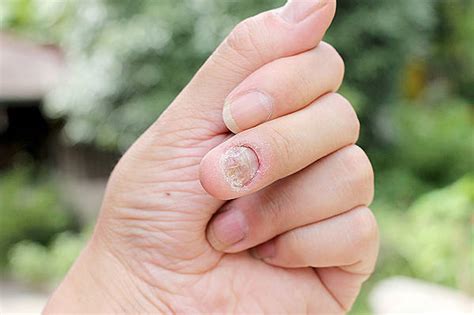 Grzybica paznokci | Objawy i leczenie grzybicy paznokci