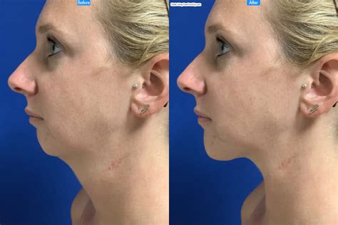 chin augmentation neck lift simulation