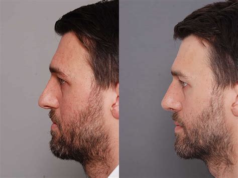 male uk rhinoplasty  keeping  masculine features