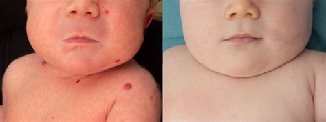 Infantile haemangiomas | The BMJ