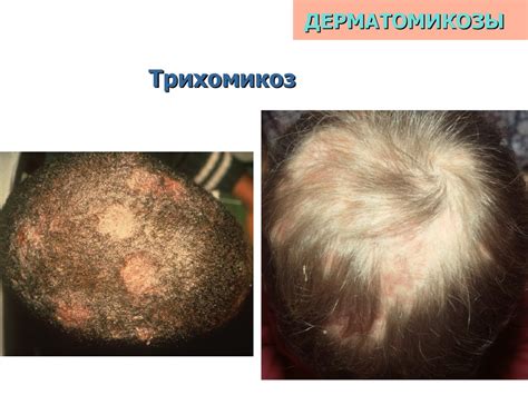 Грибковые заболевания кожи - презентация онлайн