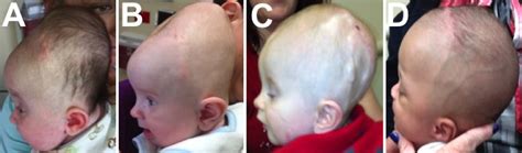 Hydrocephalus Before And After