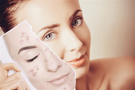 Acne Skin: Causes, Treatments & How to Manage It | Life Pharmacy