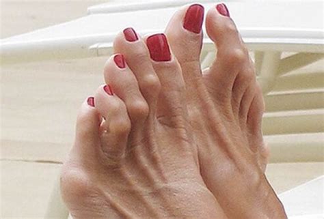 hammer toe  appearance symptoms  hammer toe treatment