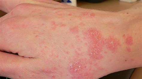 Scabies Rash Hands