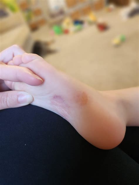 Peeling skin on toddlers foot : r/Dermatology