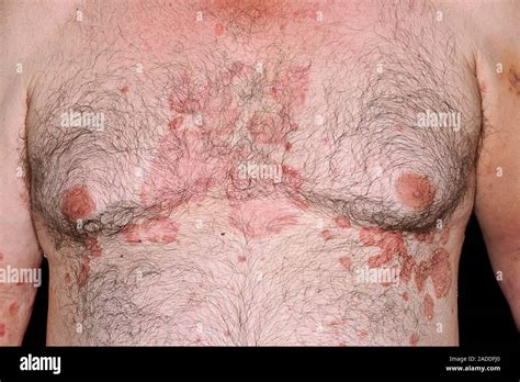 Psoriasis on the chest of a 67-year-old man. Psoriasis is the presence ...