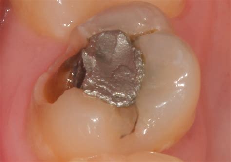 cusp teeth restored  amalgam  joann finkelstein blog
