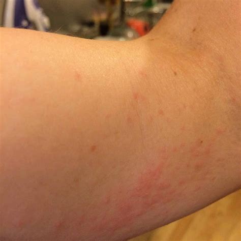 House Dust Mites: 10 Signs To Identify, Treat, And Prevent