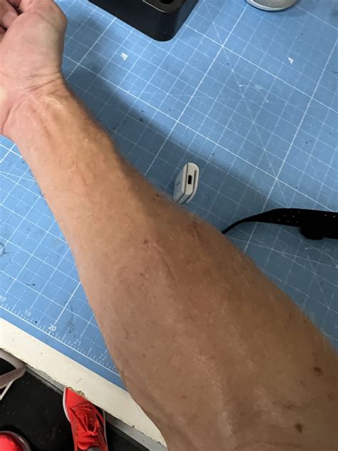 hDrop – Wearable Hydration Monitor