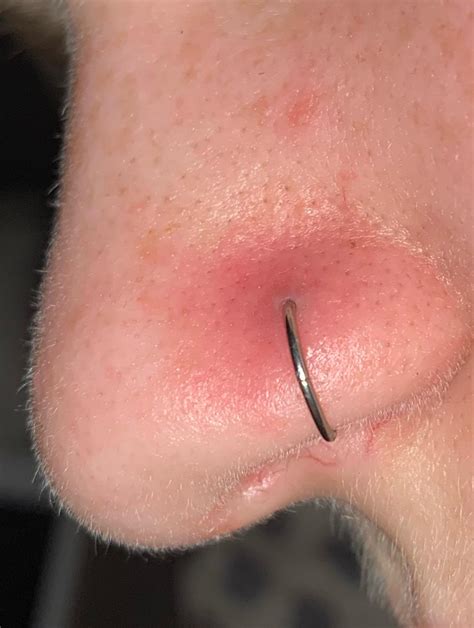 Piercing Infection: Ways To HEAL FAST Infected EAR, Nose Piercing ...