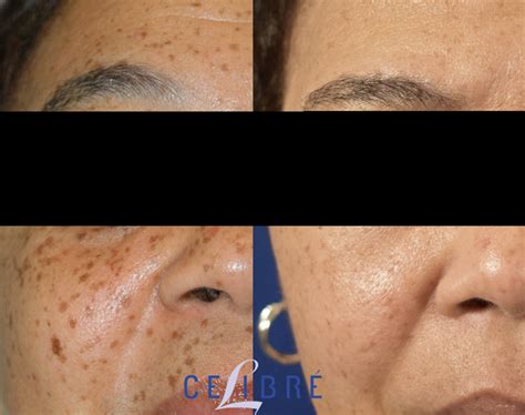 laser treatment  dark spots cost results