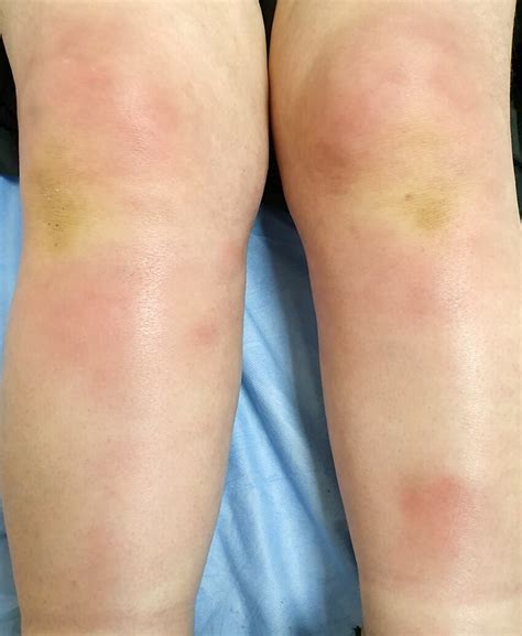 Erythema Nodosum Legs