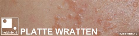 platte wratten huidinfonl dermatoloog