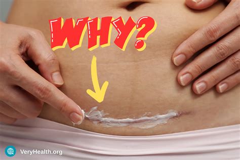 Why Does My C-Section Scar Itch After 10 Years - VeryHealth