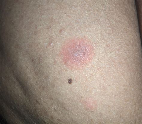 Got this itchy boil type thing on my buttcheek , it does not burn