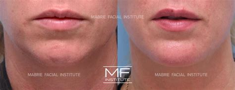 chin dimple botox   san francisco bay area mabrie facial institute