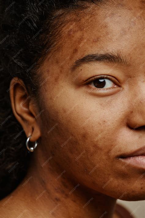 Dominique Seux Cicatrice Visage 12