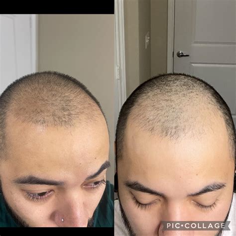 Derma Stamp Before And After Cheap Sale | centralcountiesservices.org
