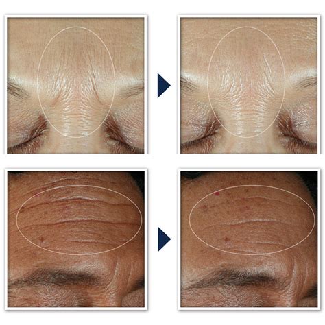 roc clinically proven products results roc skincare