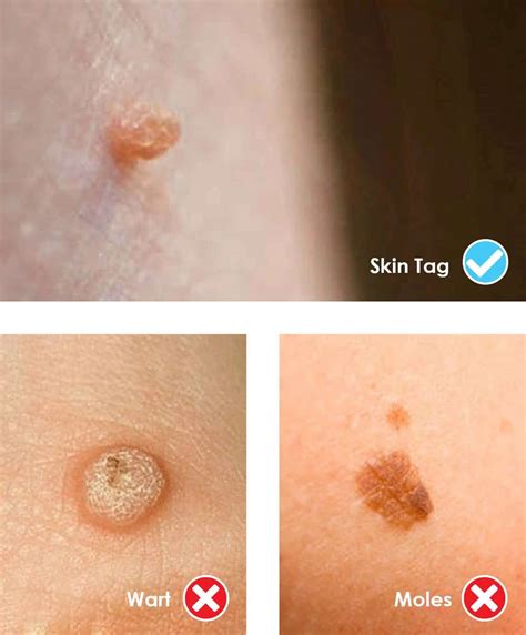 What is a skin tag? | Cryotag - Clinically Proven Skin Tag Remover