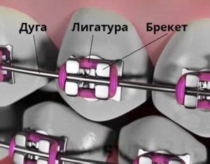 Как работают брекеты? — О брекетах от ортодонта