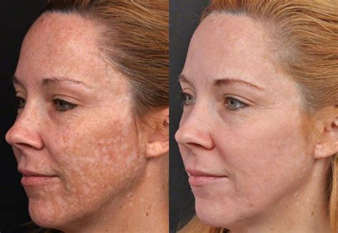 depigmentation treatment review beauty bulletin face  body
