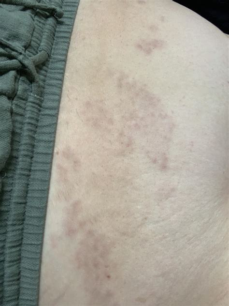 Purple rash on lower stomach for a month : r/DermatologyQuestions
