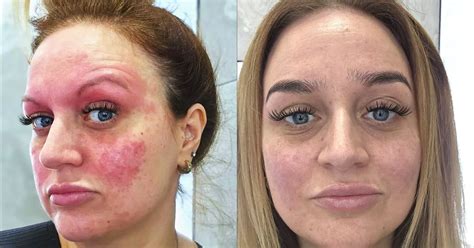 mum finds miracle acne cure   years  avoiding