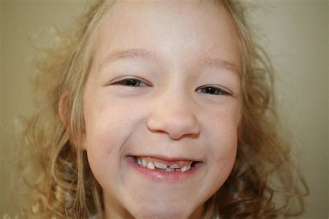 lukitsch family chronicles   front teeth