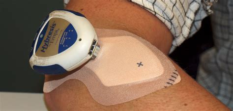 Iontophoresis Should You Be Using Iontophoresis with Your Patients