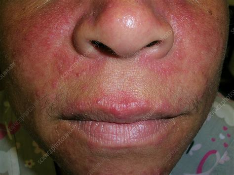 severe rosacea stock image  science photo library
