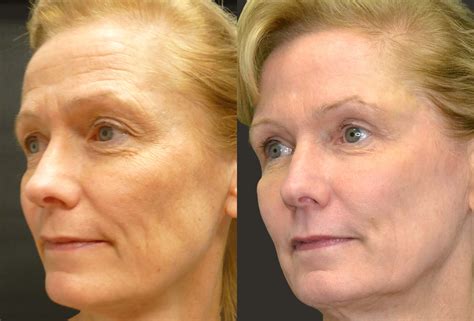 Laser Resurfacing in Northern Virginia | NOVA Plastic Surgery