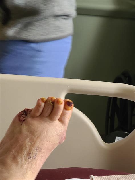 pinky toe amputation rmedicalgore