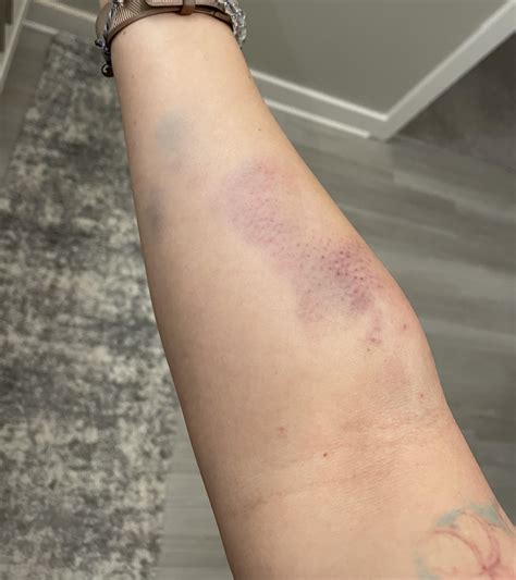 When plasma donation goes wrong… : r/mildlyinfuriating