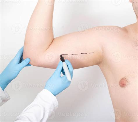 The doctor marks the place on the arm with a marker for the operation