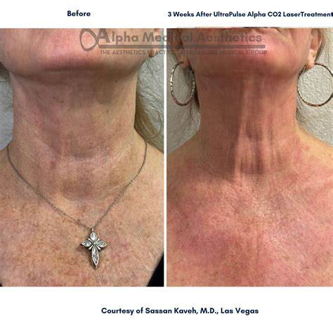 Non-Surgical Facelift in Las Vegas - Alpha Medical Aesthetics - Alpha