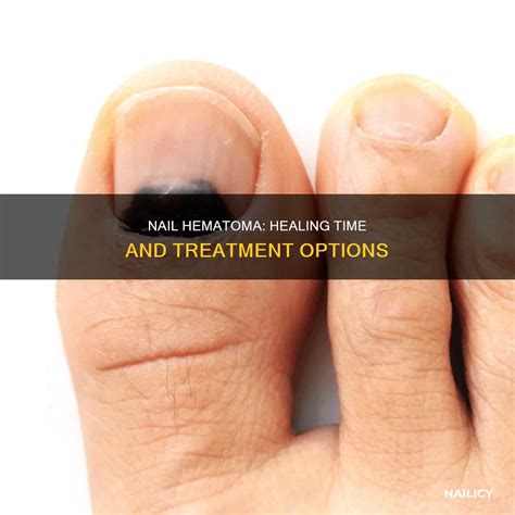how long does it take for a hematoma to reabsorb