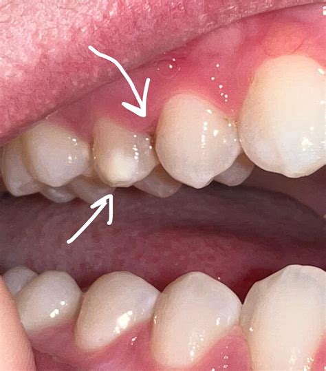 weird brown stuff   teeth raskdentists